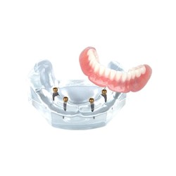 LOCATOR Overdenture Implant Model