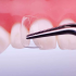 CoForm 21 Mesial