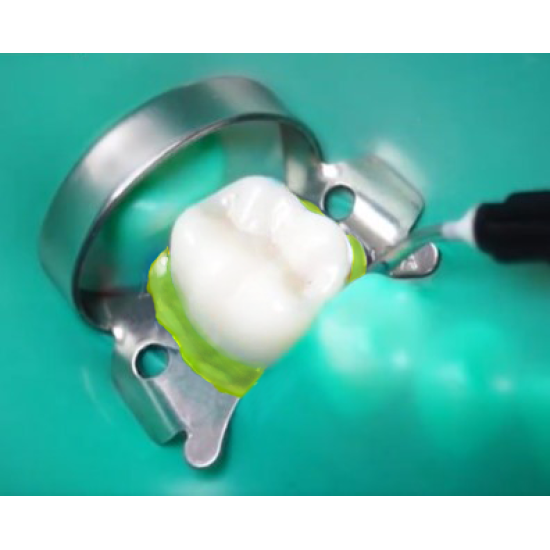 Flowdam™ Flowable Dental Dam Kit, 4 Syringe + 25 Tips